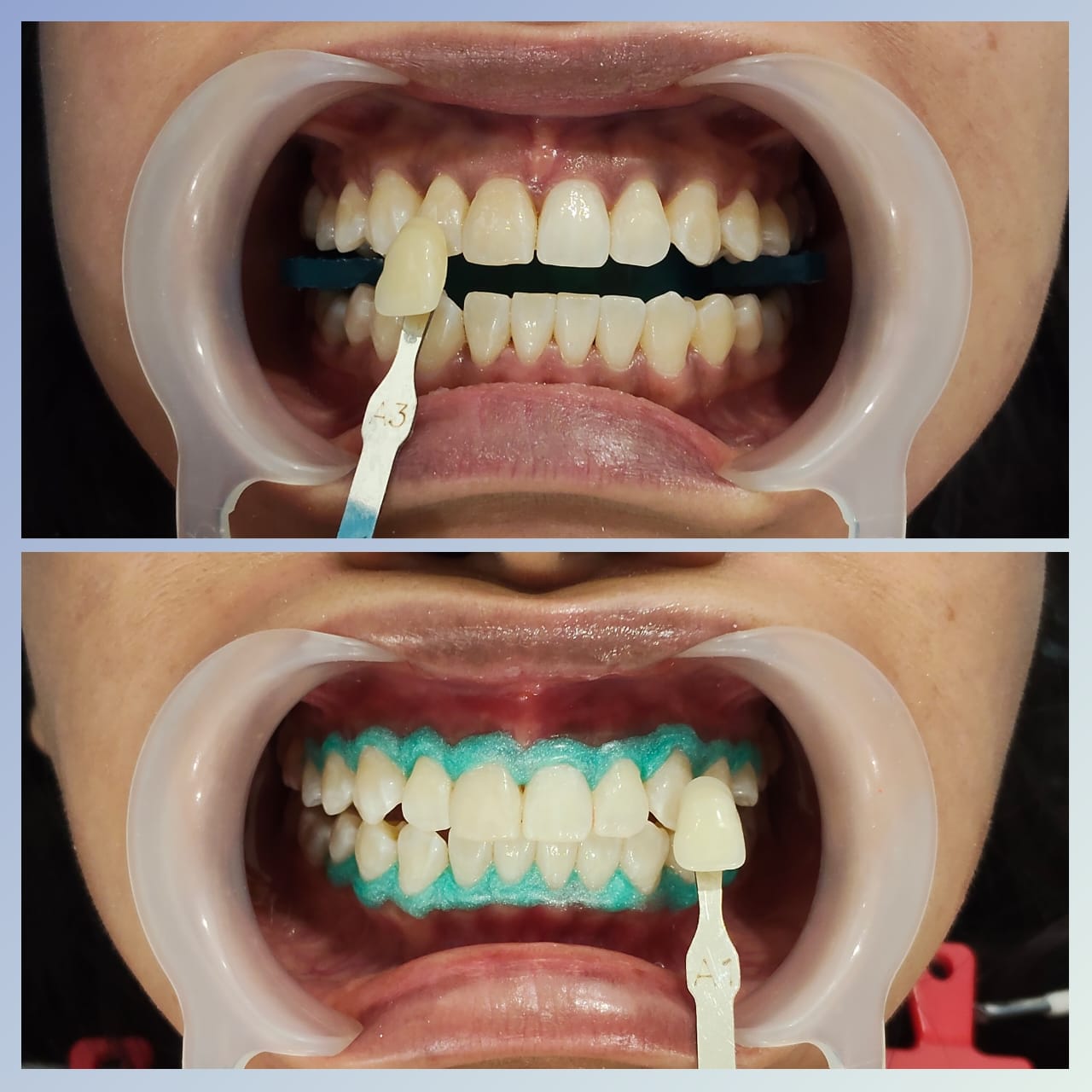 Proses rawatan whitening dan perbandingan shade gigi di Klinik Pergigian Ukasyah