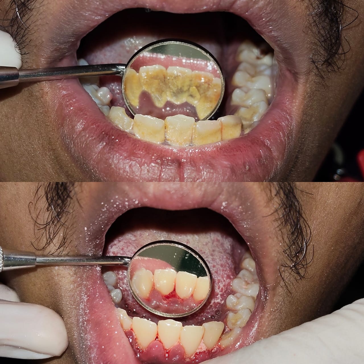 Hasil sebelum dan selepas scaling dan polishing di Klinik Pergigian Ukasyah