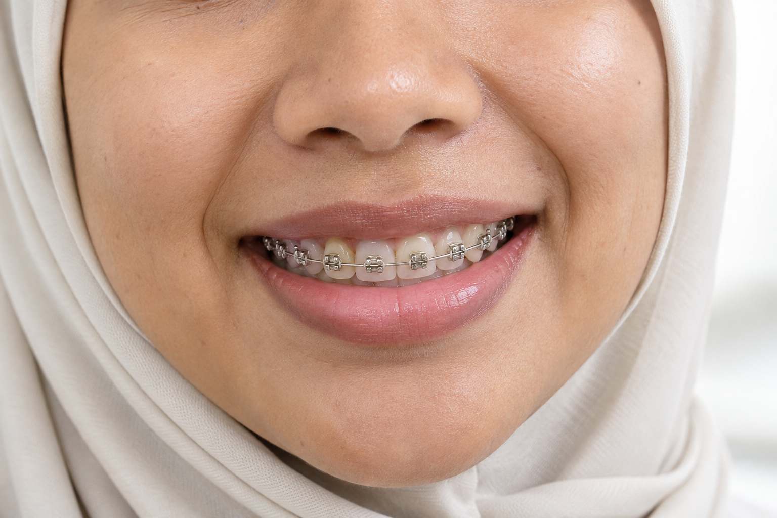 Senyuman memakai braces