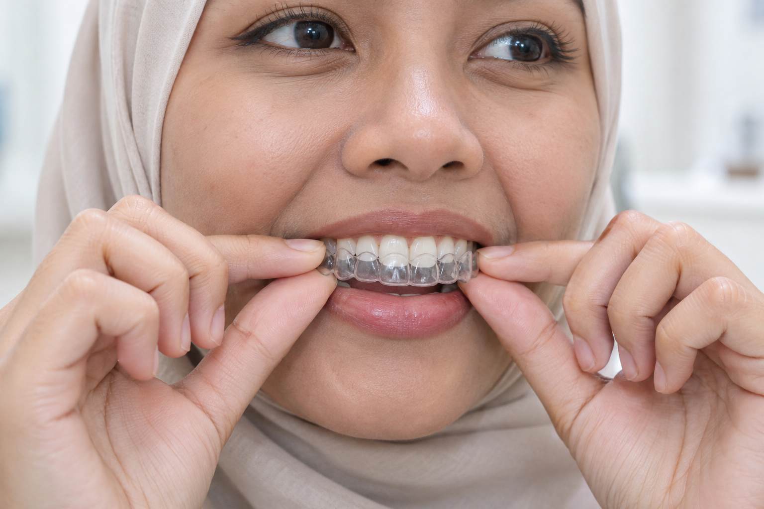 Pemakaian clear aligner pada gigi