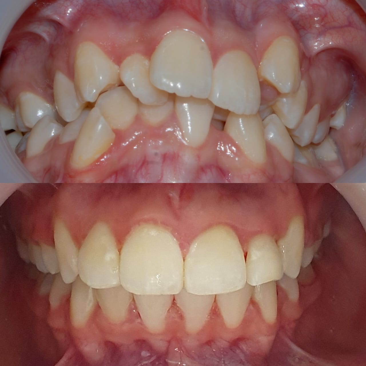 Braces treatment at Ukasyah Dental